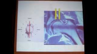 119  MRI arthrography in femoroacetabular impingement FAI [upl. by Asilrac]