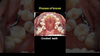 Crooked teeth braces process braces orthodontist dentist crookedteeth [upl. by Derr307]