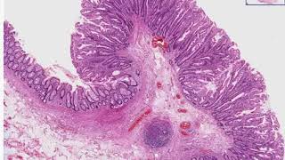 Hyperplastic Polyp Histopathology  Madeformedicalcom [upl. by Broddy]