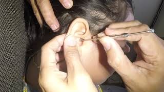 Dry Earwax Removed amp Scooped Out from Girls Ear [upl. by Aretina]