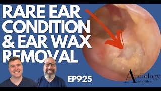 RARE EAR CONDITION amp EAR WAX REMOVAL  EP925 [upl. by Cyprio]