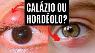 Qual a diferença entre Calázio ou Hordéolo Terçol Bolinha no olho [upl. by Eciram]