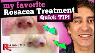 FACE FLUSHING TREATMENT  MY FAVORITE ROSACEA TREATMENT  Rosacea Cure [upl. by Peednam793]