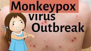 Monkeypox virus outbreak  What is monkeypox virus [upl. by Adnohsor]