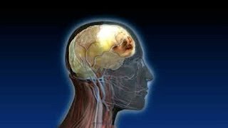 What is a Subdural Hematoma or Blood on the Brain [upl. by Neu]