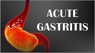 Acute Gastritis  Signs amp Symptoms Causes Pathogenesis Complications Diagnosis amp Treatment [upl. by Pierpont]