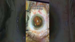 First Vivinex Gemetric trifocal lens insertion in London UK [upl. by Nelleeus]