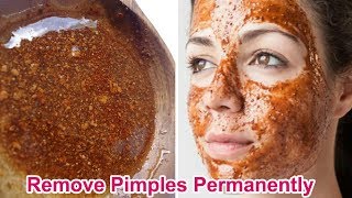 पिम्पल्स को जड़ से खत्म करने के असरदार घरेलू उपाए  How to get rid acne scars fast in 3 days [upl. by Regnij]