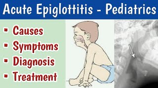 Acute Epiglottitis In Children Causes Clinical features Diagnosis and Management [upl. by Fried937]