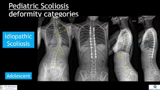 NonAIS Scoliosis Whats the difference [upl. by Taran]