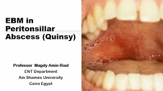 EBM in Peritonsillar Abscess Quinsy [upl. by Ambie593]