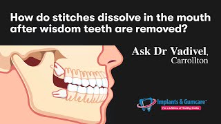 How do stitches dissolve in the mouth after wisdom teeth are removed Ask Dr Vadivel  Carrollton [upl. by Gehman]