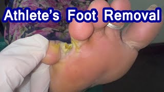 Athletes foot Removal  Fungal skin infection athletefoot [upl. by Akselav]