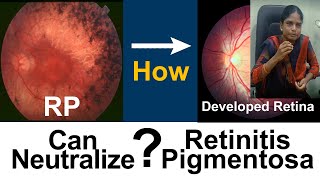 Retinitis Pigmentosa  How she got useful vision  Medical Improvement  DrSasi [upl. by Snahc590]