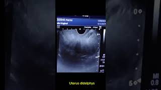 Uterus didelphys with right adnexal haemorrhage cyst [upl. by Euqinot]