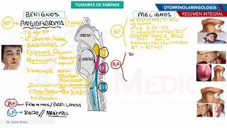 Otorrinolaringología  Tumores de faringe [upl. by Ettenirt78]