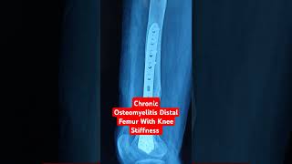 Chronic Osteomyelitis Distal Femur With Knee Stiffness Dr Sai Chandra [upl. by Simdars425]