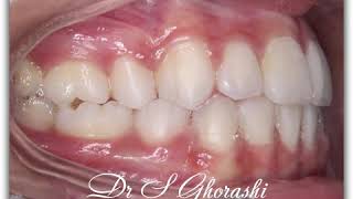 16bimaxillary protrusion  Drghorashi [upl. by Nevla]