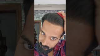 Hair Transplantation Results After 4 Months LaDensitae Hairtransplantation Results Kerala [upl. by Litsyrk805]