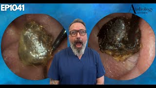 The Most Shocking Ear Wax Removal Youve Never Seen  EP1041 [upl. by Erlinna]