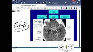 NS Medicine Subarachnoid Hemorrhage [upl. by Regine883]