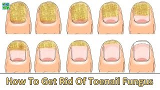 How to Get Rid of Toenail Fungus Fast and Naturally  Home Remedies [upl. by Prader]