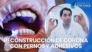 Elección de Pernos y Adhesivos  Clínica Dentistas por Chile [upl. by Neerehs]