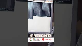 Hip fracture fixation intertrochantericfracture [upl. by Nnylrefinnej62]