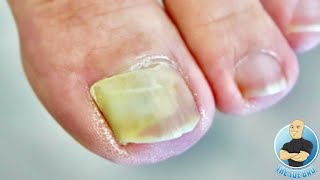 DAMAGED BIG TOENAIL COMPLETELY LIFTED HOW TO TREAT LIFTED TOENAILS [upl. by Atteloiv]