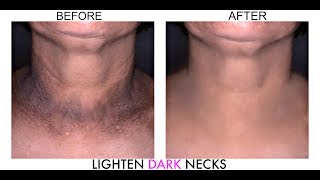 DARK NECK HOME REMEDIES  HOW TO GET RID OF DARK NECK NATURALLY IN 5MINS  OMABELLETV [upl. by Hitchcock]