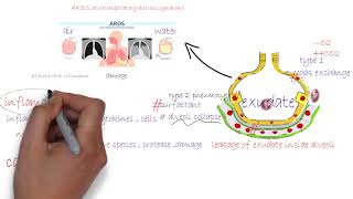 ARDS acute respiratory distress syndromeشرح [upl. by Fosdick]