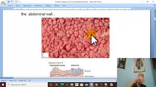 Intestinal Disorders in Arabic 11 Familial Polyposis Coli   by Dr Wahdan [upl. by Cartwell]