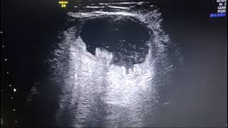 Ileal Conduit Ultrasound Picture [upl. by Loziram419]