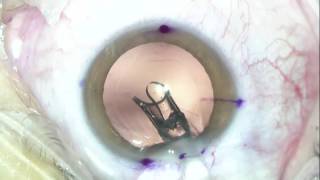 Implantation of newly approved toric trifocal IOL [upl. by Bedelia]