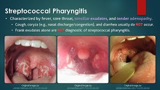 Streptococcal Pharyngitis [upl. by Akeit567]