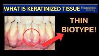 Gingival Recession Treatment How to Check the Keratinized Gingival Tissue Periodontal Maintenance [upl. by Nnahoj]