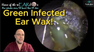 GREEN INFECTED EAR WAX 249 ear earwax earwaxremoval earcleaning asmr fyp foryou satisfying [upl. by Thekla408]