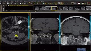 Schwannoma on brain MRI With Drs Stephen Pomeranz and Malcolm Shupeck [upl. by Jadda]