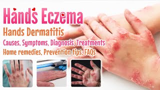 Eczema Hands overview causes sign and symptoms diagnosis treatment home remedies FAQs extend [upl. by Quincey]