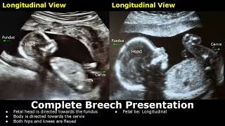 Fetal Presentations Ultrasound Images  CephalicBreechFrankFootlingFunic Fetus  Fetal Lie USG [upl. by Mehta]