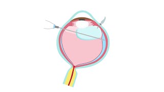 Retinal Detachment Treatment—Pars Plana Vitrectomy [upl. by Scarrow]