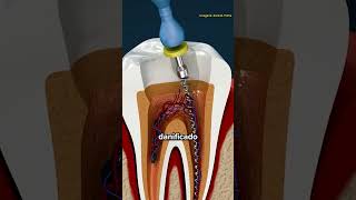 Como É Feito Um Canal no Dente [upl. by Netneuq]