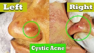 Drainage de lacné kystique sur le nez  cystic acne extraction [upl. by Alemrac]