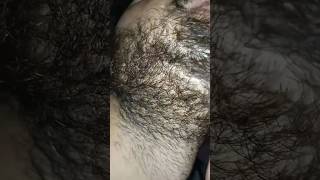 beard hair longer Carly problem beard hairproblem barber barbershop ingrownhair hairremoval [upl. by Valentin]