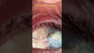 Corneal opacity after keratoplasty [upl. by Ailb]