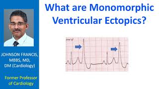 What are monomorphic ventricular ectopics [upl. by Sosthena]