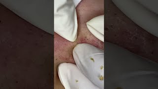 Big Cystic Acne Blackheads Extraction Blackheads amp Milia Whiteheads Removal Pimple Popping shorts [upl. by Esidarap]