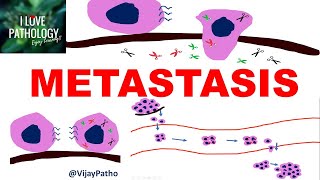 NEOPLASIA 8 INVASION AND METASTASIS Mechanisms Pathways of Spread [upl. by Henn]