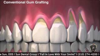 No Cutting Gum Graft with Pinhole Surgical Procedure [upl. by Aerdnaed]