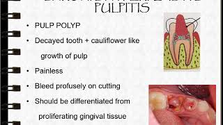 Sequelae of Pulpitis Part 1 [upl. by Giovanna48]